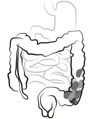 Illustration of Constipation